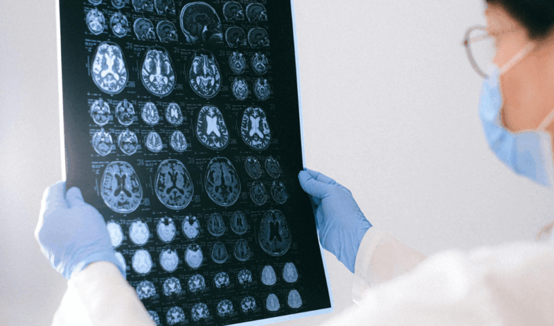 traumatic brain injury va disability benefits traumatic brain injury va disability benefits